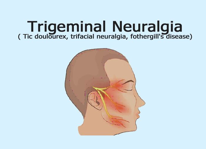 Trigeminal Neuralgia Trigger Points