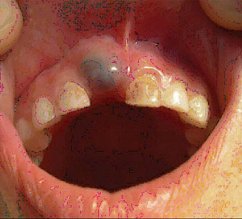 ERUPTIVE CYST