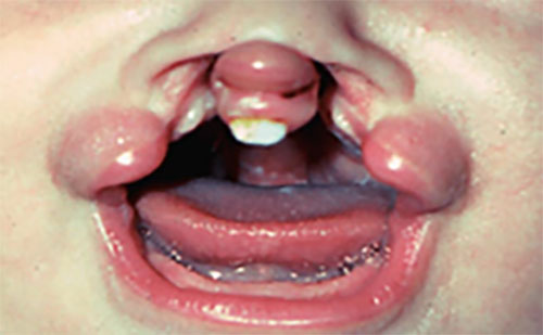 child-teeth1