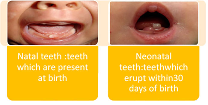 neonatal teeth