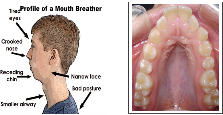 mouthbreather