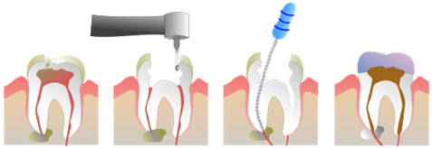 teeth-screw