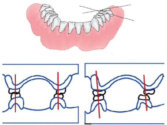 Denture-III