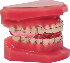 Myofunctional appliances -MCQs - Focus Dentistry