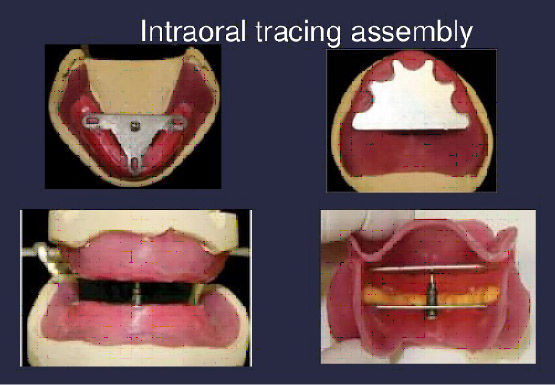 denture-2