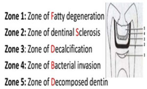 Dental caries - MCQs - Focus Dentistry