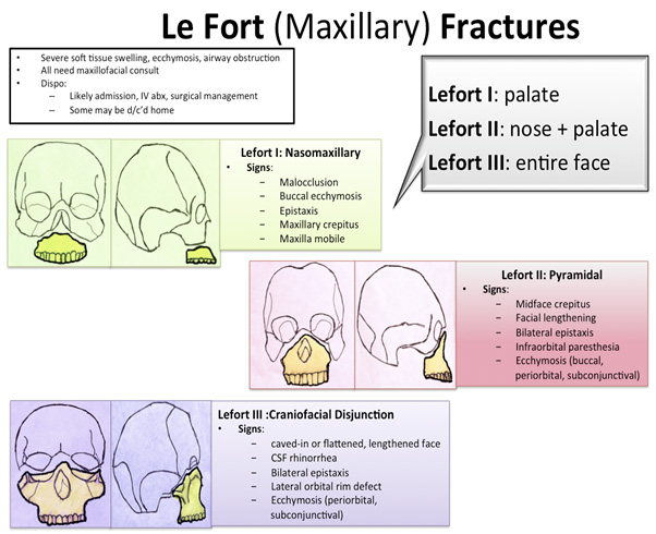 le fort fracture repair surgical count