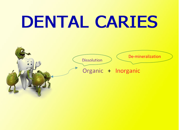 Dental Caries Focus Dentistry