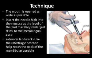 Local Anaesthesia - MCQs - Focus Dentistry