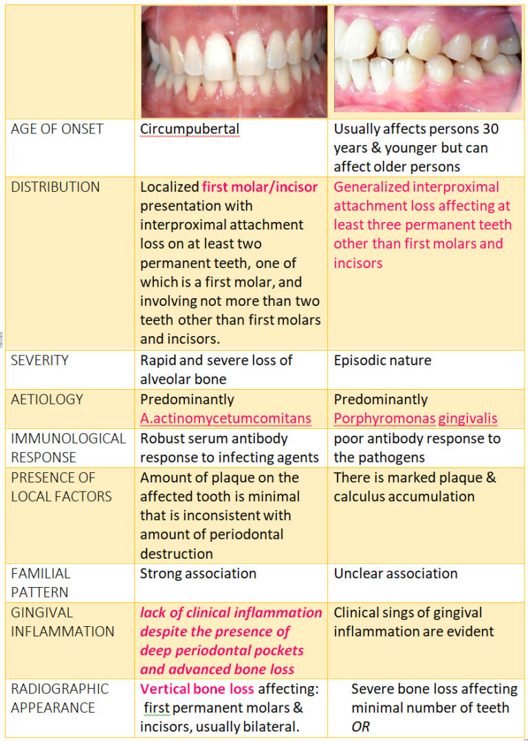 Aggressive Periodontitis Focus Dentistry