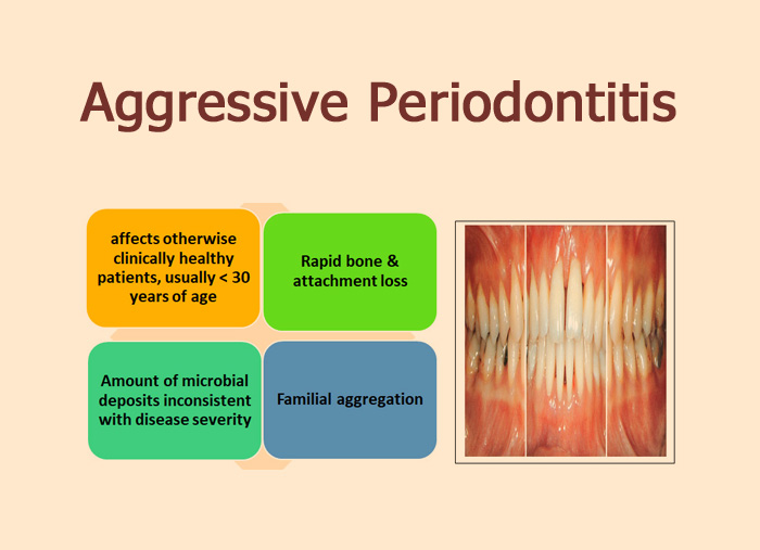 Aggressive Periodontitis Focus Dentistry