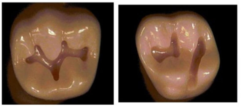 cavity-preparation-focus-dentistry