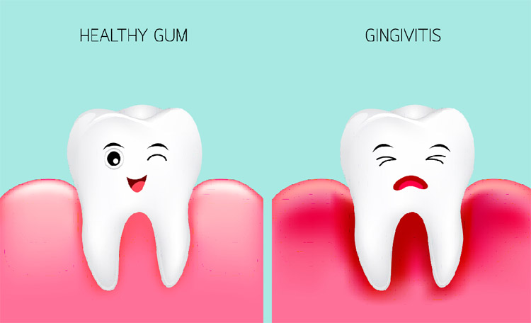 Gingivitis - Focus Dentistry