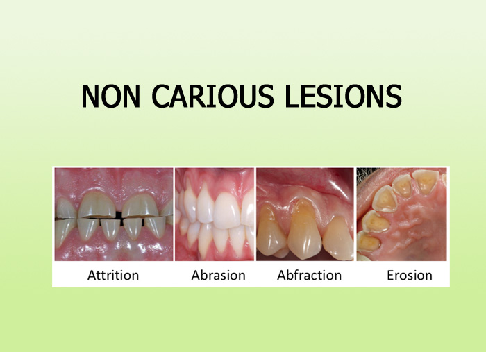 Eruption Sequence Of Tooth - Focus Dentistry