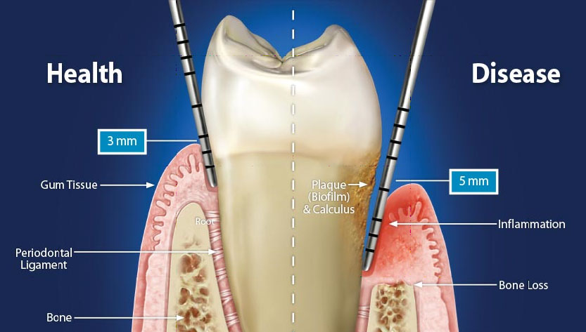 Pocket - Focus Dentistry