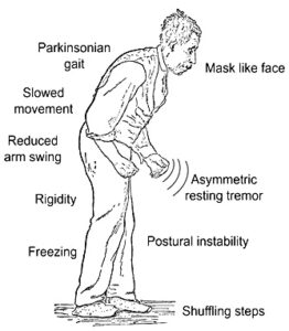 Parkinson’s Disease - Focus Dentistry