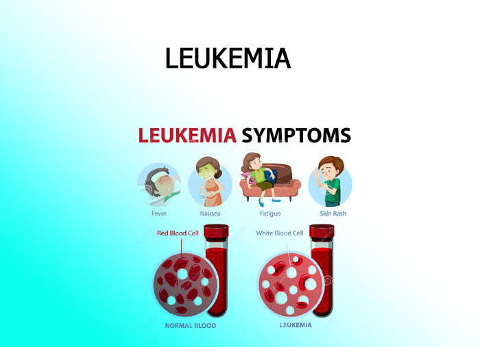 Leukemia - Focus Dentistry