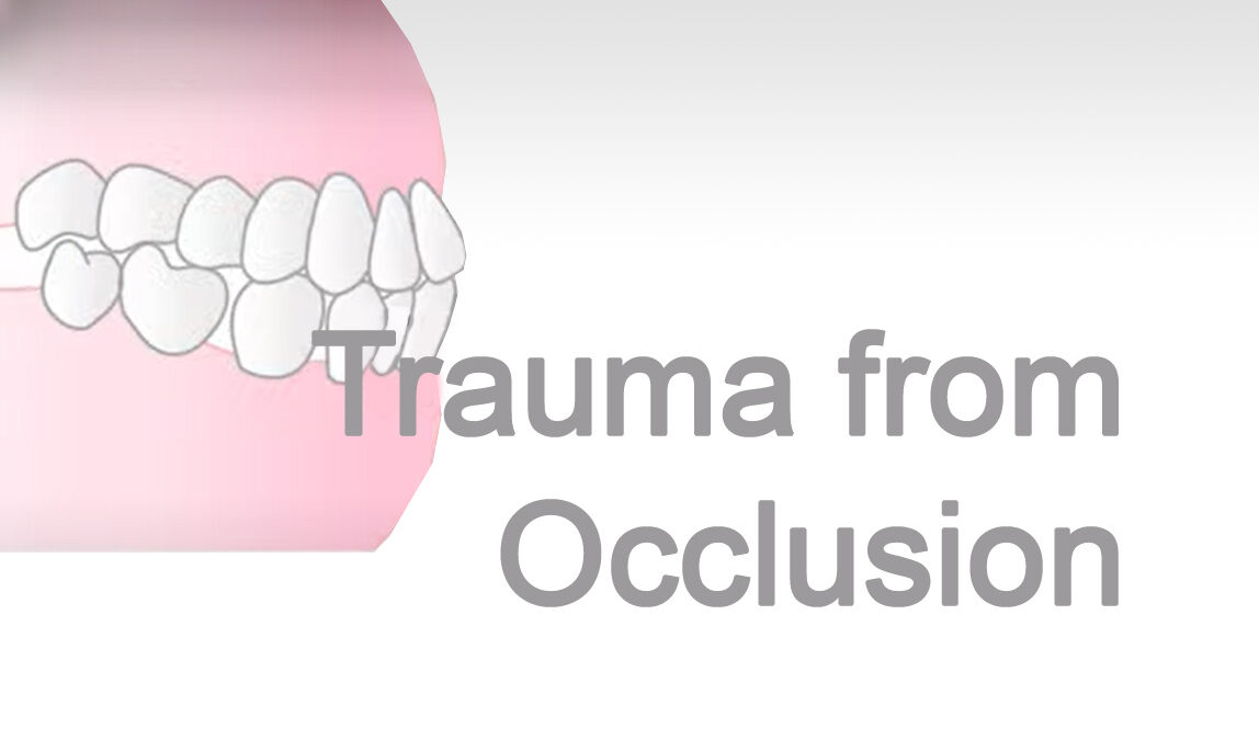 Trauma-from-Occlusion