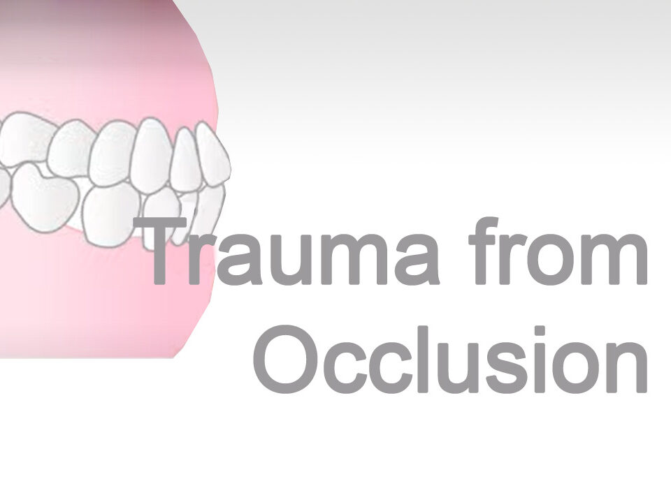 Trauma-from-Occlusion