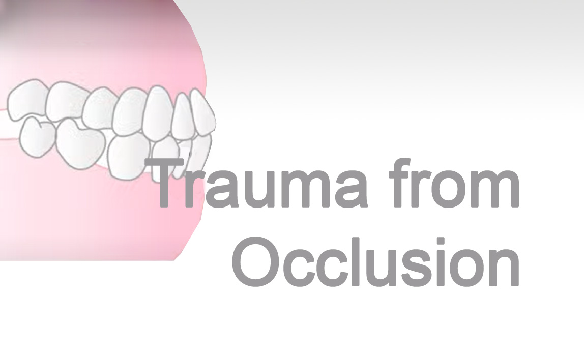 occlusal trauma signs