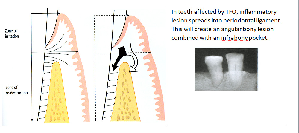 Trauma-from-Occlusion