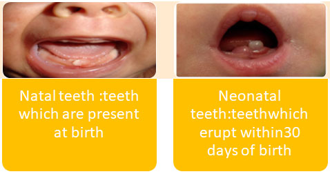 Natal and Neonatal Teeth - Focus Dentistry