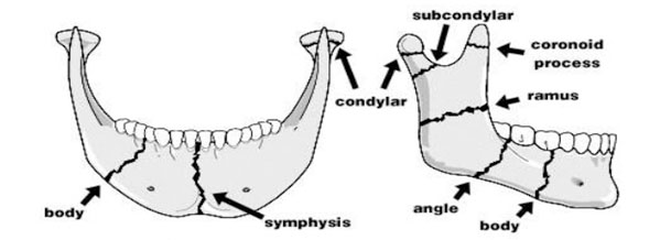 Types Of Mandibular Fractures