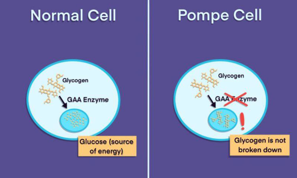 GLYCOGEN STORAGE DISEASES