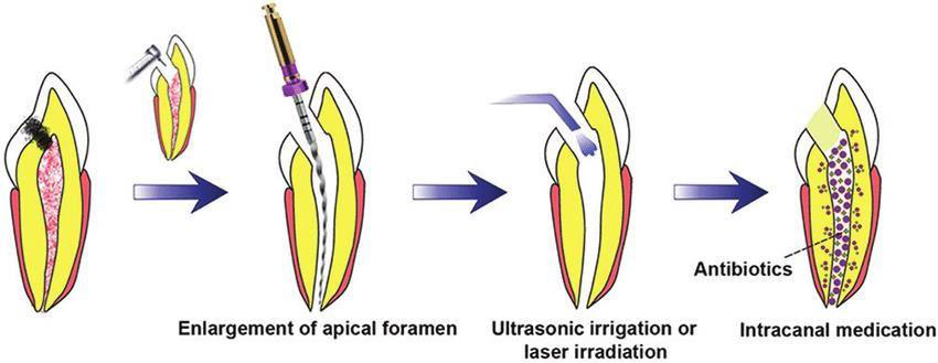 intracanal medicament academic blog