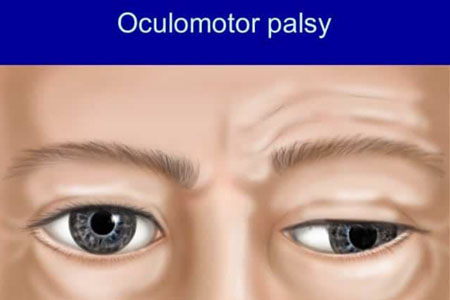 Oculomotor palsy