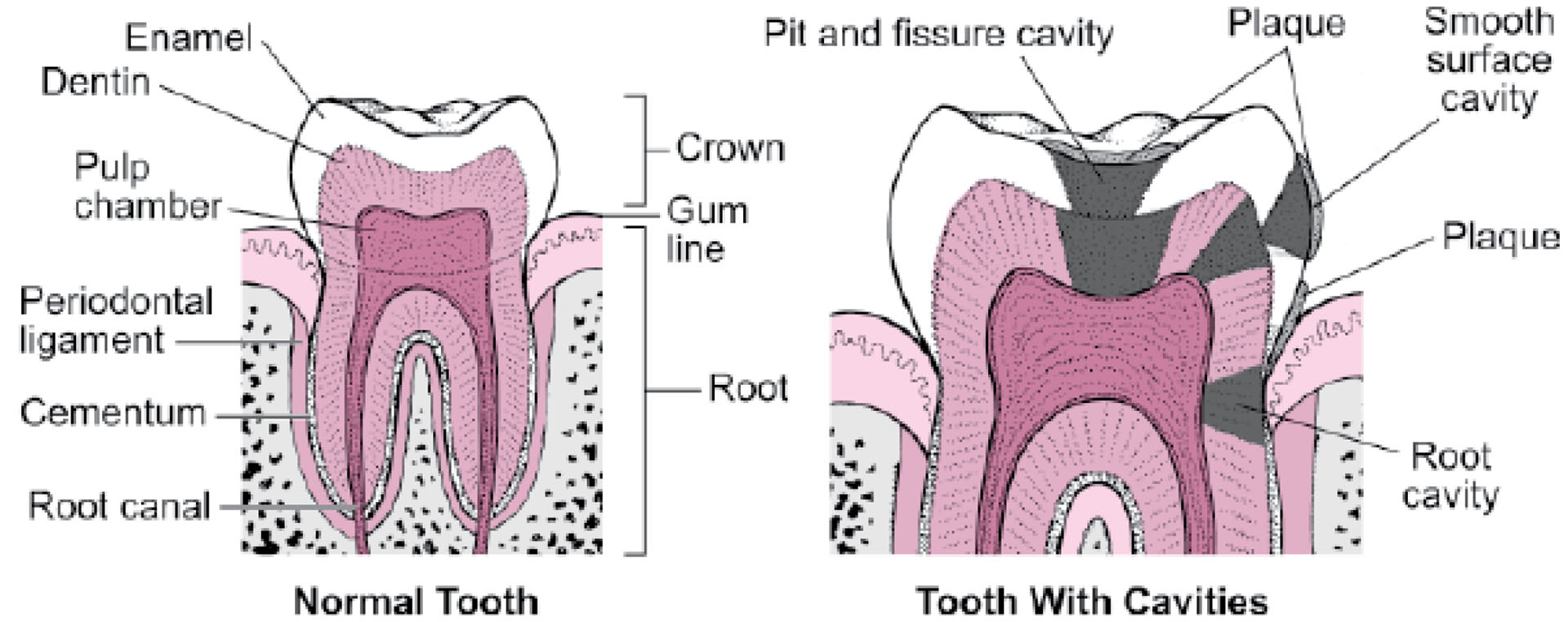 DENTAL CARIES_