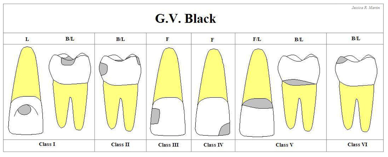 DENTAL CARIES_2