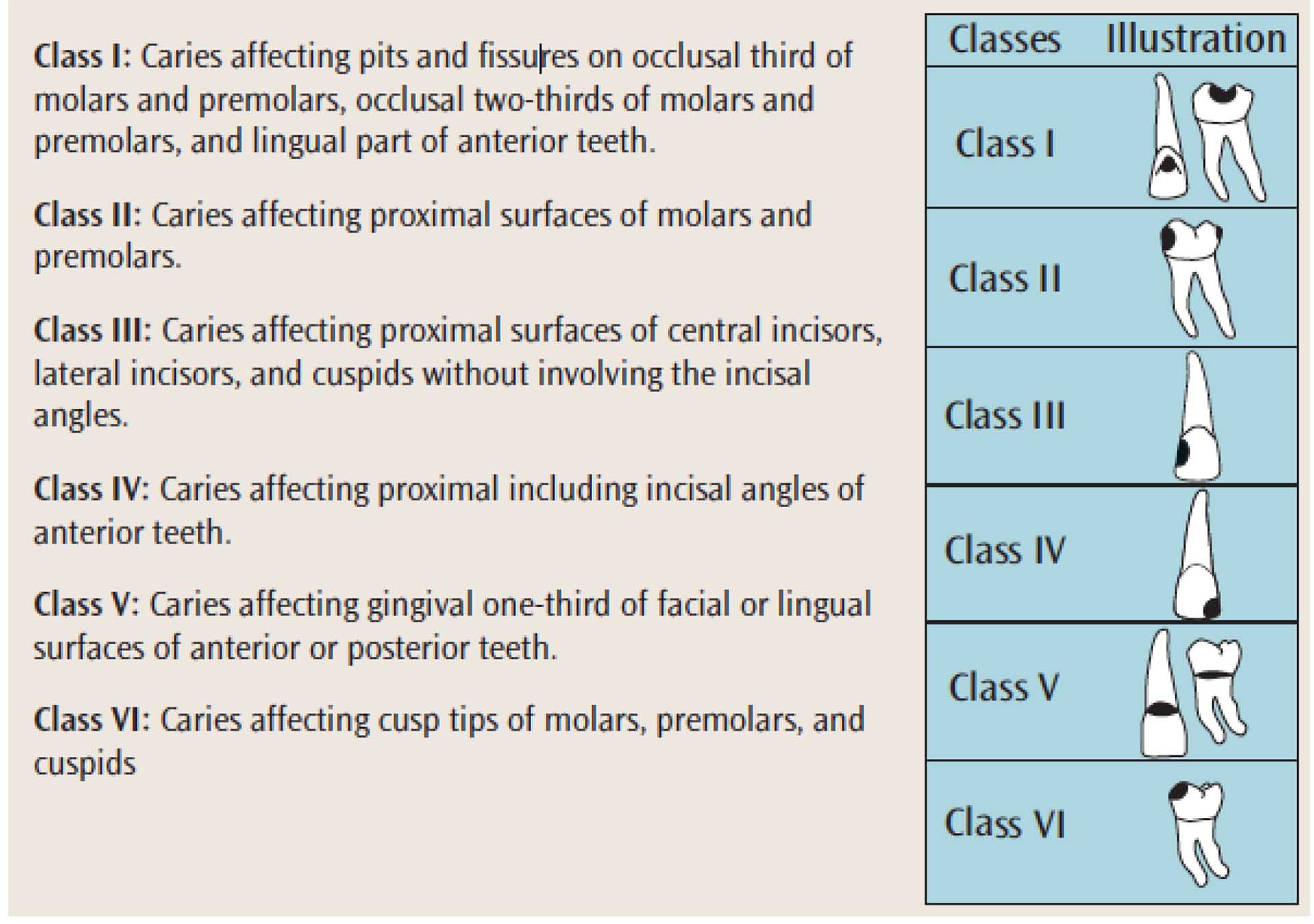 Dental Caries Classification Gv Black at James Tucker blog