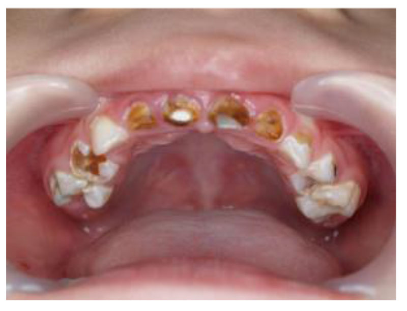 EARLY CHILDHOOD CARIES