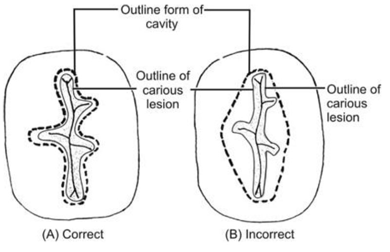 FUNDAMENTALS OF TOOTH PREPARATION