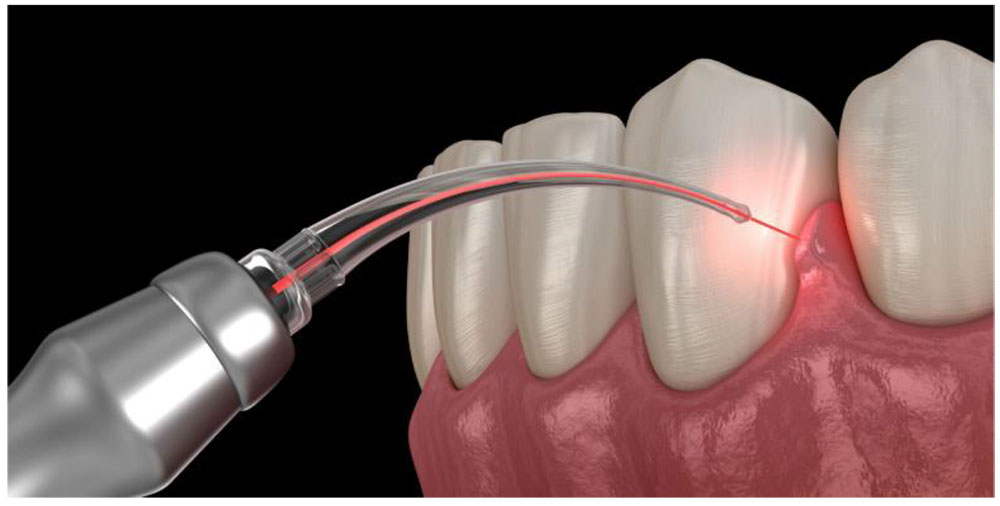 LASER IN DENTISTRY