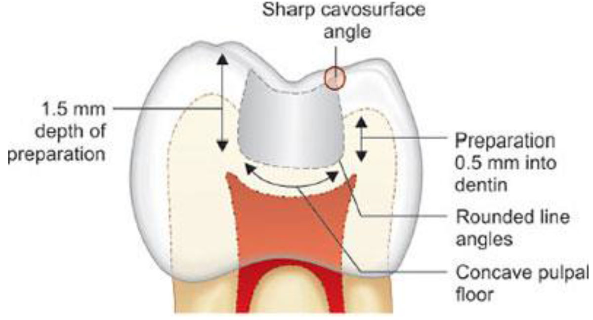 TOOTH PREPARATION