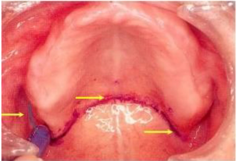 ANATOMICAL LANDMARKS MAXILLA_2