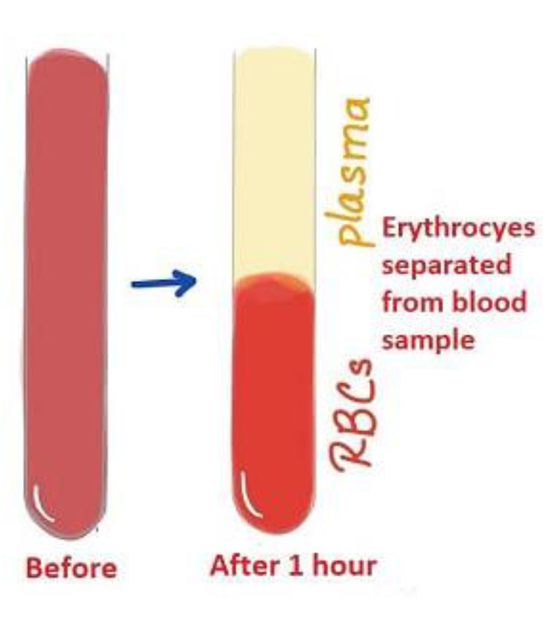 Erythrocyte Sedimentation Rate Uses, Procedure, Results, 55% OFF