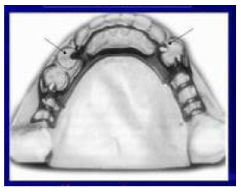 PROSTHODONTICS PAST MCQ part 3-1