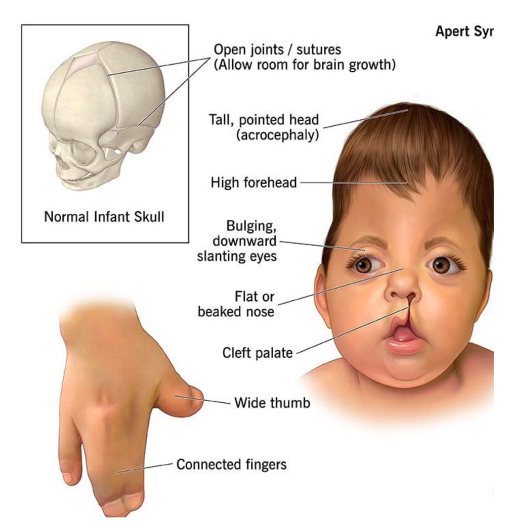 APERT SYNDROME_1