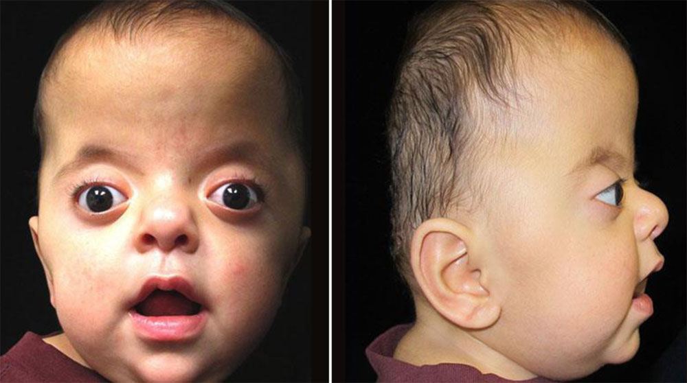 APERT SYNDROME_5