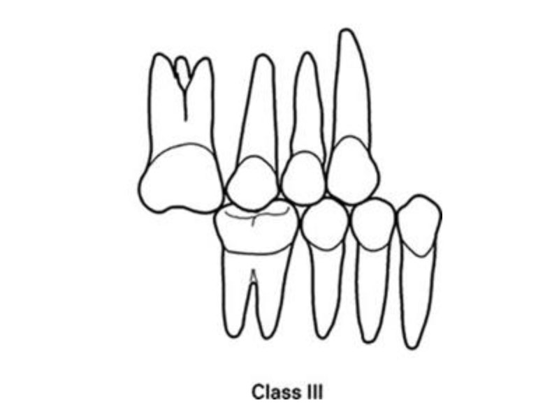 denta_lschool - Developed by Edward H. Angle in 1890, the Angle  Classifications are based on the relationship of the buccal groove of the  mandibular first permanent molar and the mesiobuccal cusp of