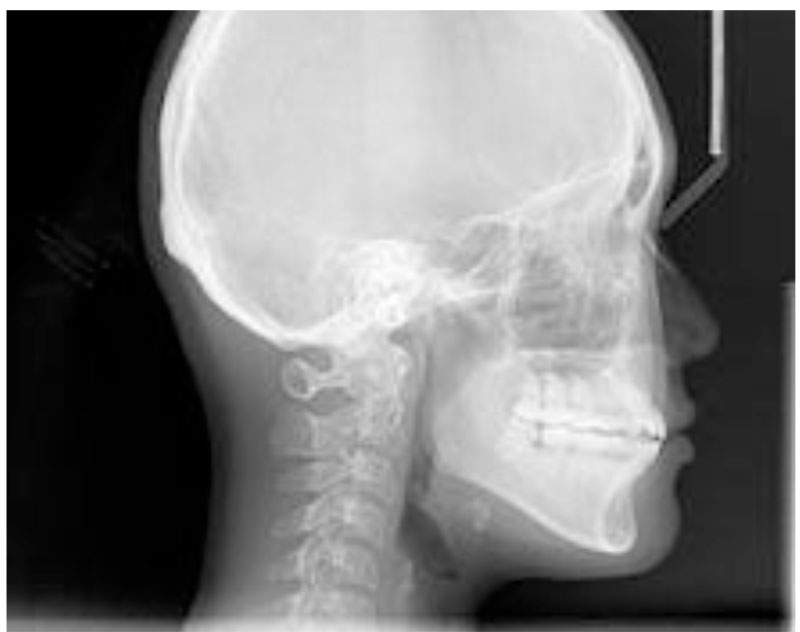 CEPHALOMETRIC LANDMARKS-1