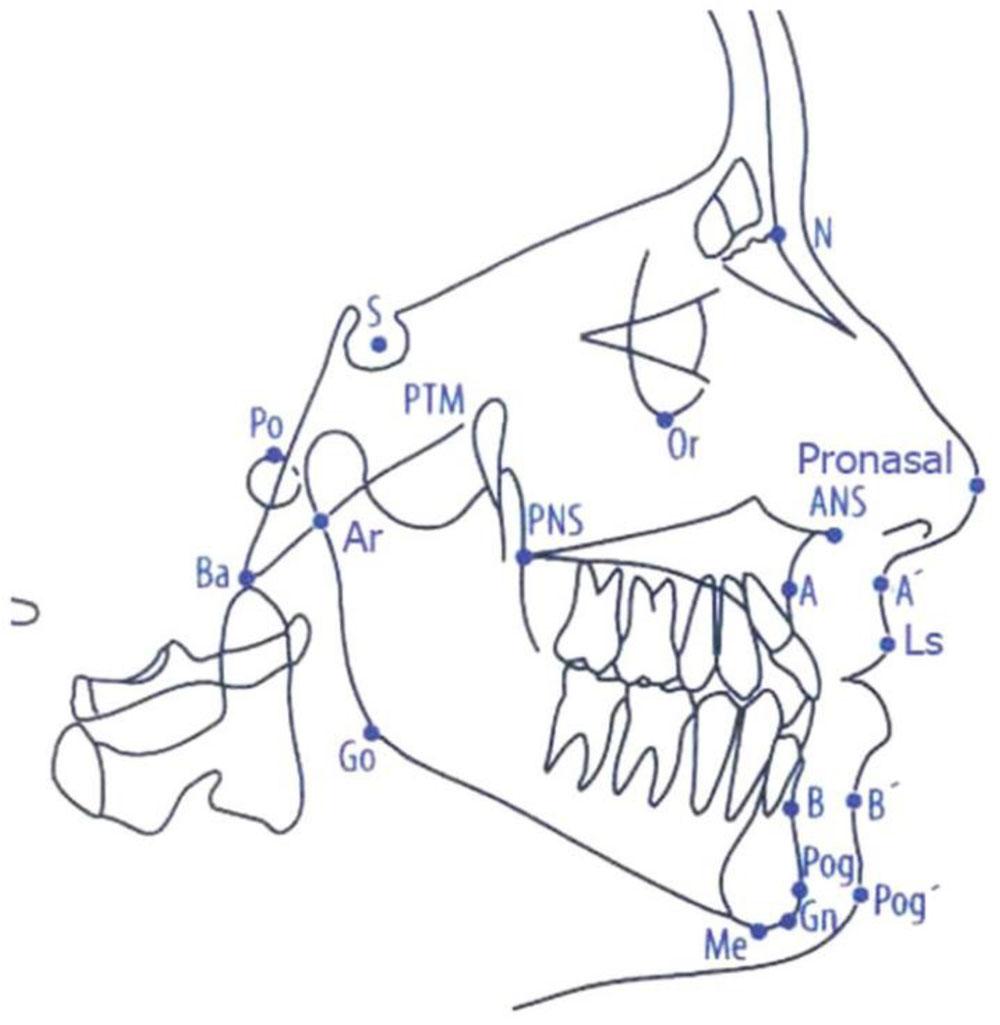 Cephalometric Landmarks Bolton