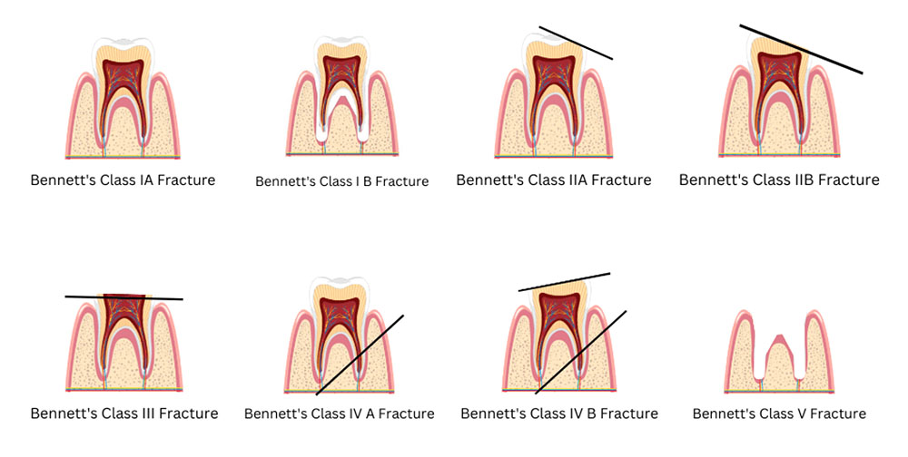 Tooth fracture classification - Focus Dentistry
