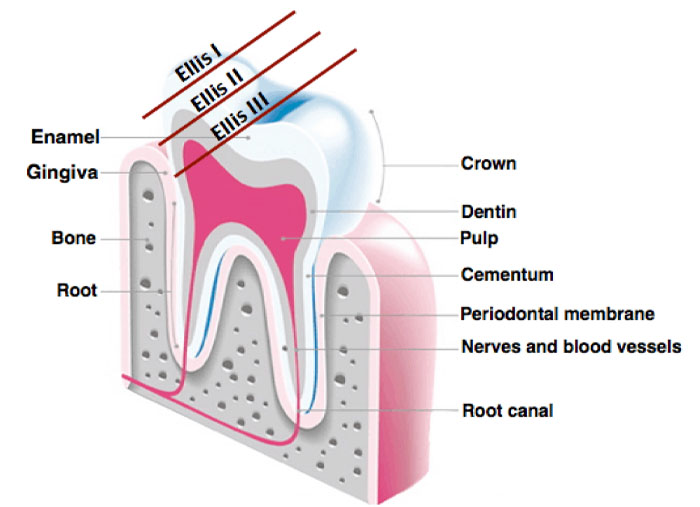 tooth fracture classification