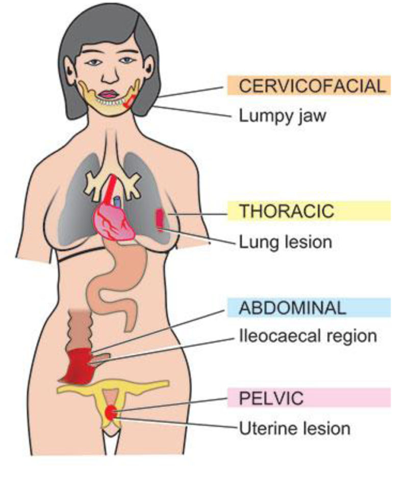 ACTINOMYCOSIS_2