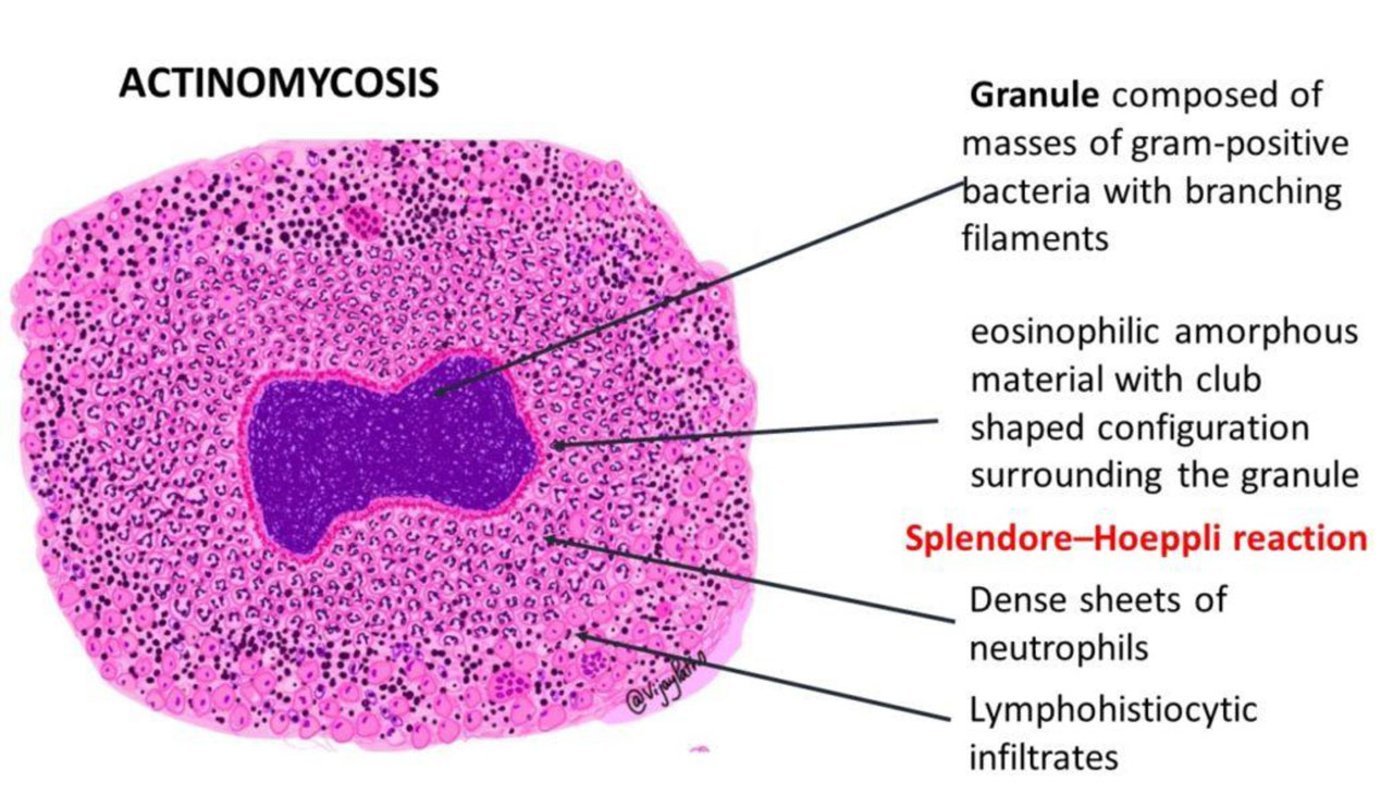 ACTINOMYCOSIS_6