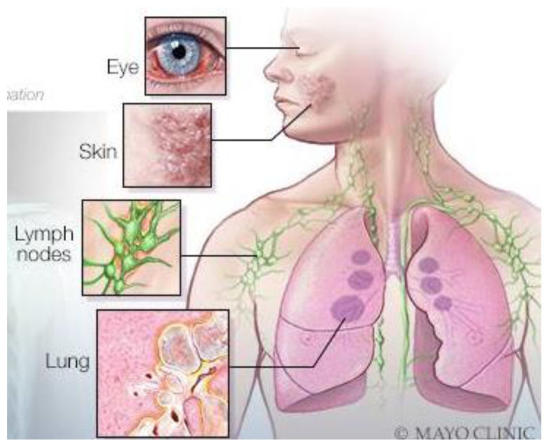 SARCOIDOSIS_1